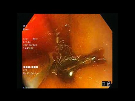 Endoscopia con luz blanca vs Imágenes de banda estrecha (NBI) vs cromoendoscopia (yodo de Lugol)