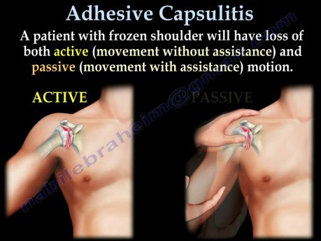 Capsulitis adhesiva y hombro congelado - video-clase