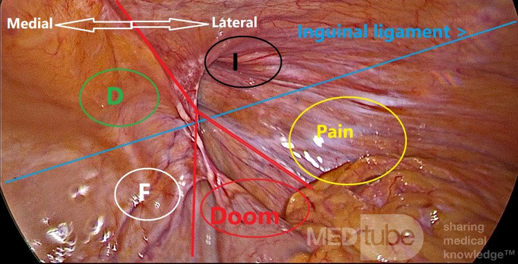 Hitos en la reparación laparoscópica de hernias