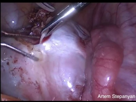Extirpación laparoscópica de un quiste dermoide