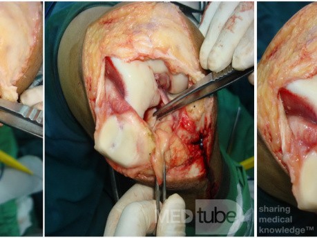 Osteocondritis disecante 