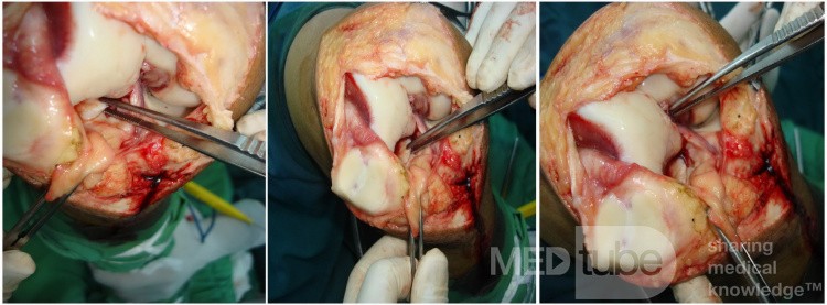 Osteocondritis disecante 