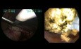 Exploración laparoscópica de CBC con extracción de 45 cálculos intra y extrahepáticos. 