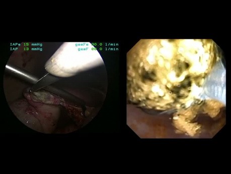 Exploración laparoscópica de CBC con extracción de 45 cálculos intra y extrahepáticos. 