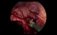Colecistectomía laparoscópica para colecistitis litiásica aguda con hígado cirrótico e hipertensión portal, con colecistostomía percutánea