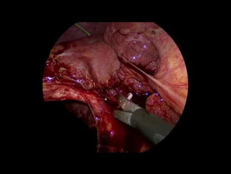 Colecistectomía laparoscópica para colecistitis litiásica aguda con hígado cirrótico e hipertensión portal, con colecistostomía percutánea