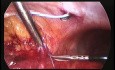 Transposición laparoscópica del uréter retrocavo y anastomosis ureteroureteral