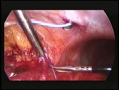 Transposición laparoscópica del uréter retrocavo y anastomosis ureteroureteral