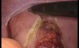 Rectopexia laparoscópica con malla posterior para el prolapso del recto