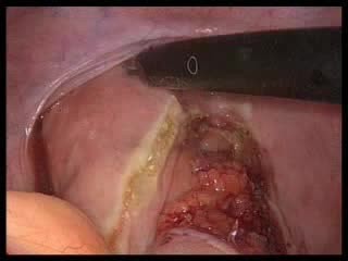Rectopexia laparoscópica con malla posterior para el prolapso del recto