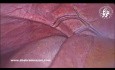Surcos accesorios en la superficie diafragmática del hígado