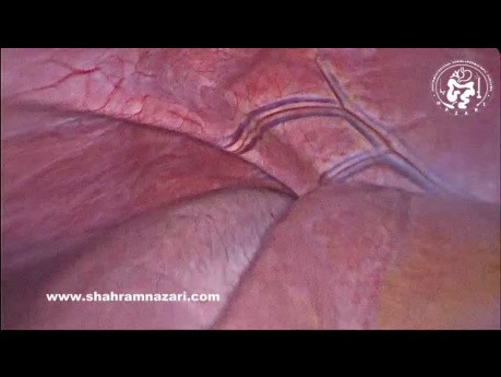 Surcos accesorios en la superficie diafragmática del hígado
