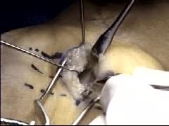 Cirugía del túnel carpiano