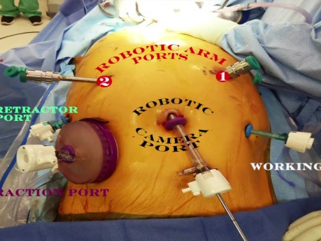 Esofagectomía transhiatal robótica