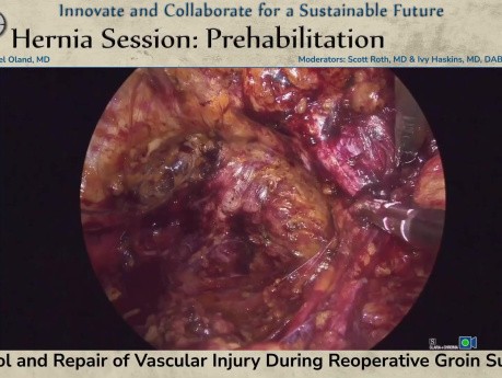 Control y reparación de lesiones vasculares durante la cirugía de reintervención inguinal