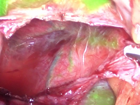 Uso de cirugía guiada por fluorescencia ICG durante la fenestración laparoscópica de quistes hepáticos