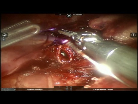 Tumor carcinoide con la cirugía robótica