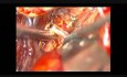 Aneurisma cerebral - bifurcación de la arteria media - clipping