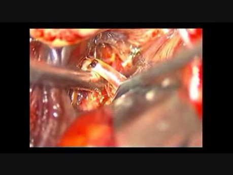 Aneurisma cerebral - bifurcación de la arteria media - clipping
