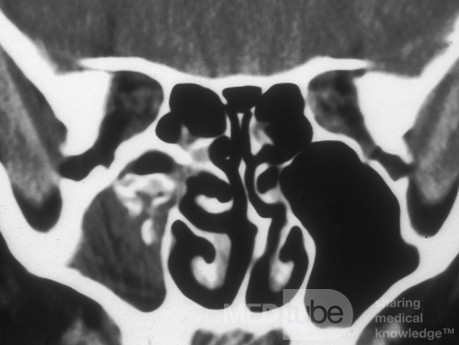 Sinusitis micótica [tomografía computarizada]