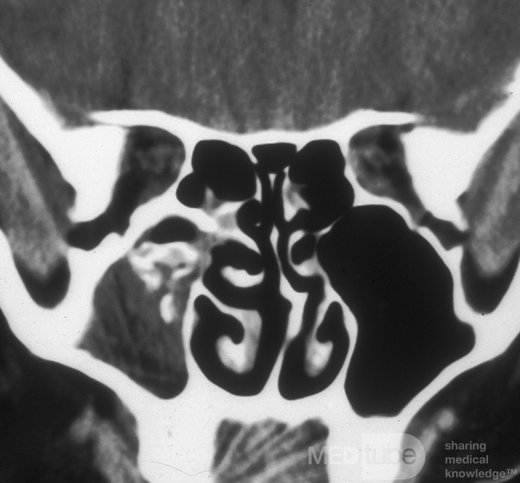 Sinusitis micótica [tomografía computarizada]