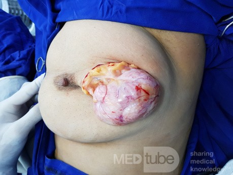 Fibroadenoma gigante