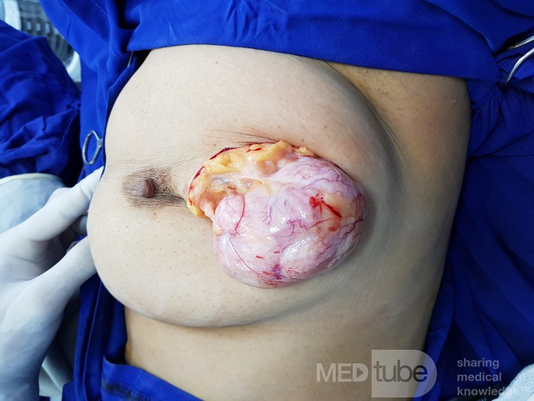 Fibroadenoma gigante