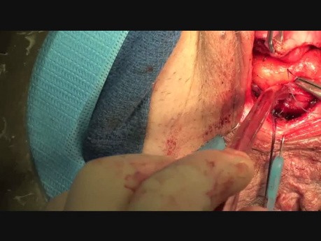 Reparación de rectocele - técnica transvaginal con malla y levatorplastia