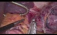 Resección laparoscópica de GIST del fundus del estómago
