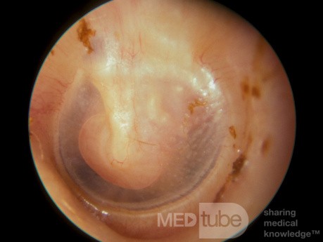 Neuroma del nervio facial del oído medio