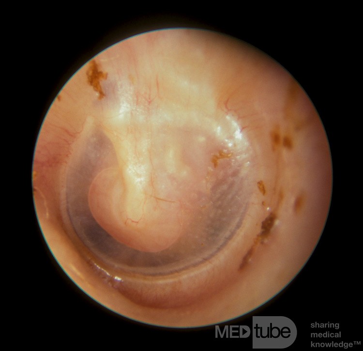 Neuroma del nervio facial del oído medio