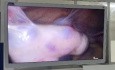 Dolor pélvico con Hidrosalpinx gigante adherencia a la pared abdominal 
