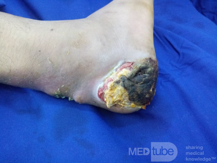 Úlcera del talón diabético con infección de Aquiles