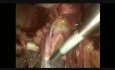 Abordaje combinado minilaparoscópico (TEP-TAPP) para la hernia inguinal