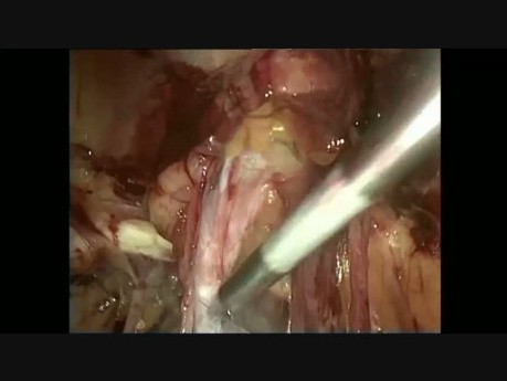 Abordaje combinado minilaparoscópico (TEP-TAPP) para la hernia inguinal