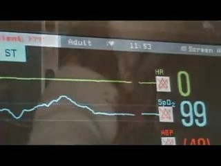 Reemplazo de la válvula mitral despierto: modo EP de preservación de cuerdas