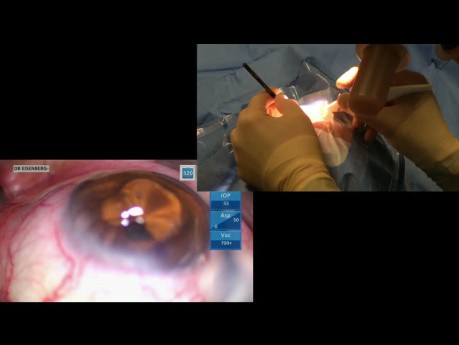 Nueva Técnica de Implante Microstent para Glaucoma para Acceder a Ubicaciones Laterales Temporales