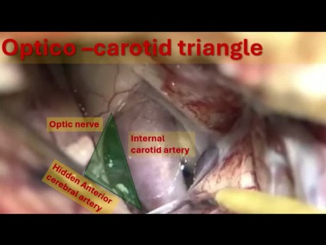 Triángulo carotídeo óptico