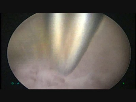 Resección del septo uterino durante la histeroscopia