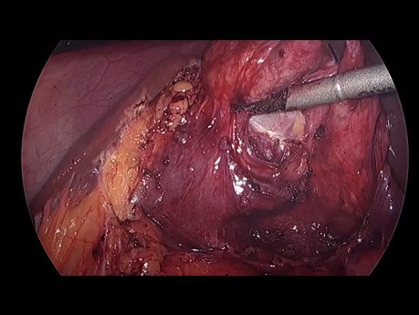 Colecistectomía Laparoscópica Difícil