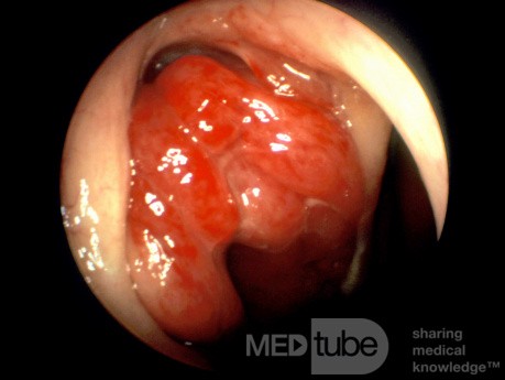 Tumor nasofaríngeo