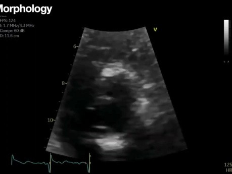 Evaluación ecocardiográfica de la estenosis aórtica