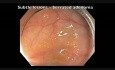 Colonoscopia - lesión plana sutil