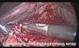Funduplicatura Laparoscópica Redo Dor con Cardiomiotomía de Heller