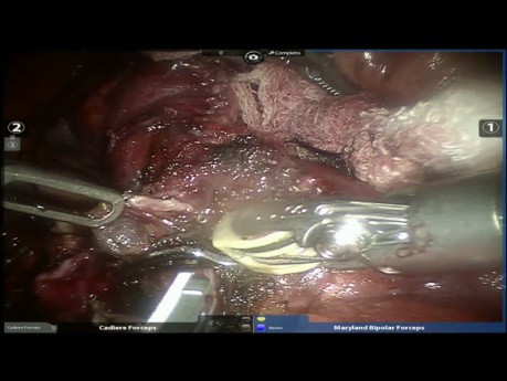 Segmentectomia Pulmonar Anatomica S2 - Cirurgia Robotica