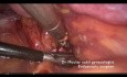 Ligadura de la arteria ilíaca interna y miomectomía