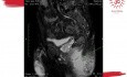 Fístula en herradura antes y después del tratamiento por RM en ano con absceso isquiorrectal