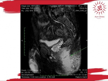 Fístula en herradura antes y después del tratamiento por RM en ano con absceso isquiorrectal