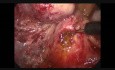 Exploración laparoscópica del conducto biliar común después de la colecistectomía.