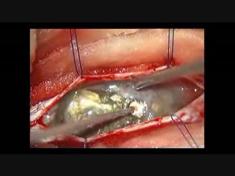 Epidermoide intradural espinal: extirpación microquirúrgica